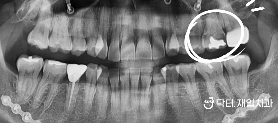 오래된 금니 깨짐 떨어짐 탈락이 발생한 경우에 금인레이 주위에 충치나 치아크랙이 있다면 어금니크라운치료가 필요할 수 있습니다