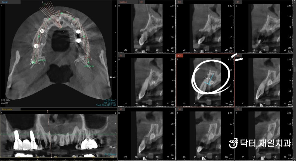 노인임플란트 수술 시 전체 어금니 먼저하고 앞니는 마지막에 잇몸뼈 녹고 과잉치발치까지 해서 핑크포셀린 pink porcelain 으로 보철치료 feat. 혈전용해제 복용과 수면치료