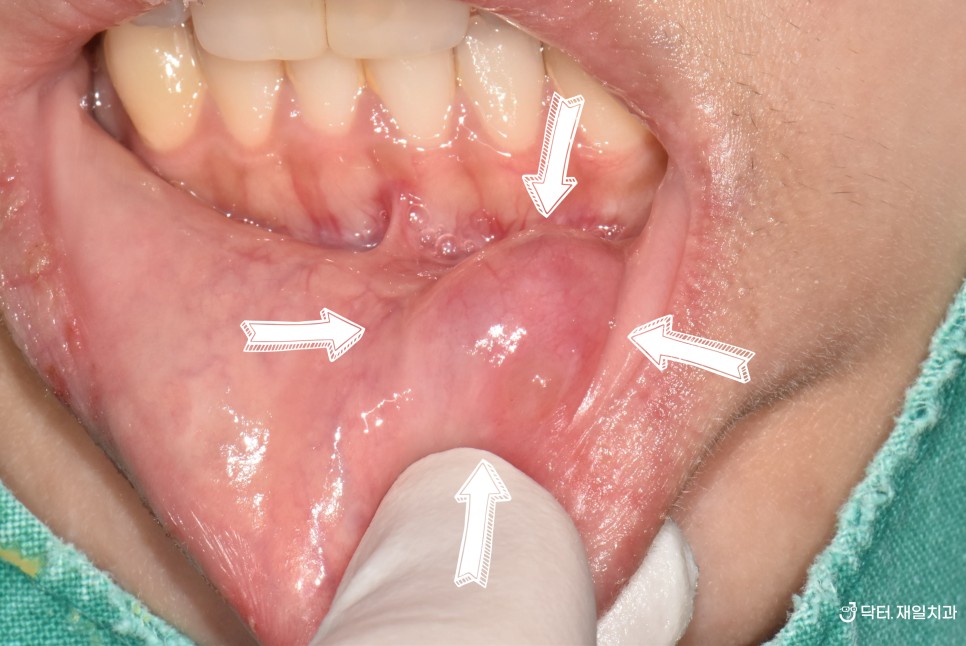 입술씹었을때 깨물었을때 안쪽에 발생할 수 있는 점액낭종 입술물혹은 치과에서 치료받으세요 "입안물집이 커졌다 작아졌다하는데 안없어져요"
