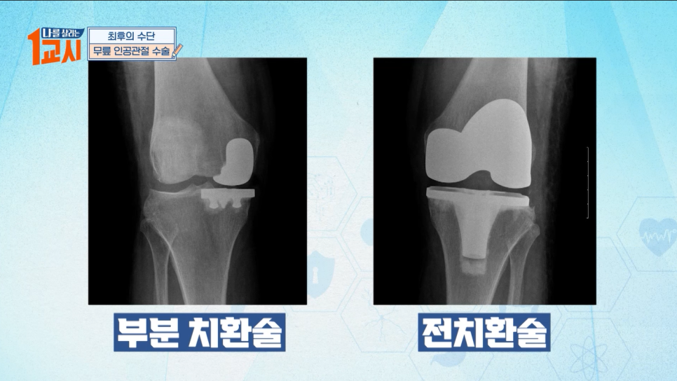 [MBC 나를 살리는 1교시] 연세사랑병원 무릎관절센터 고용곤, 서동석 의료진 퇴행성관절염&류마티스관절염 특강