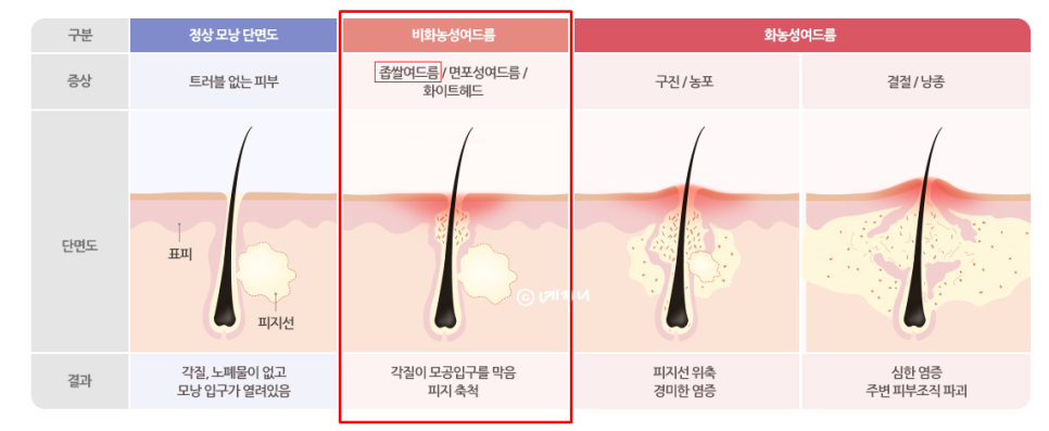 피부 오돌토돌 원인 및 해결 방법