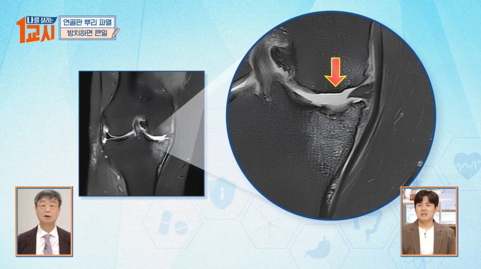 [MBC 나를 살리는 1교시] 연세사랑병원 무릎관절센터 고용곤, 서동석 의료진 퇴행성관절염&류마티스관절염 특강