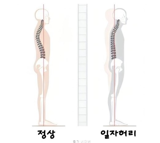 허리디스크 운동 일자 허리 통증 스트레칭