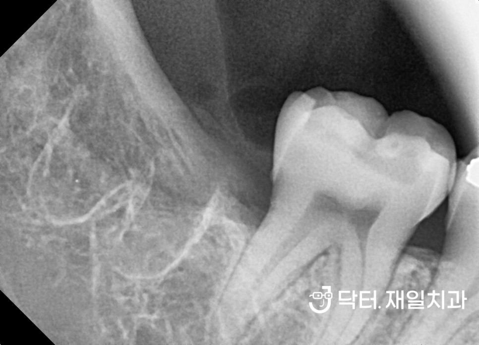 강동구사랑니 잘뽑는곳에서 치과 발치후통증과 후유증을 줄이며 수면으로 한번에 4개 feat. 의식하진정요법을 통한 매복 사랑니발치 가격 비용