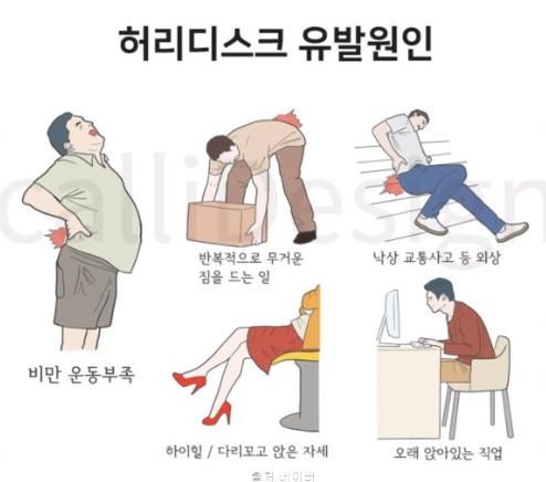 허리디스크 운동 일자 허리 통증 스트레칭