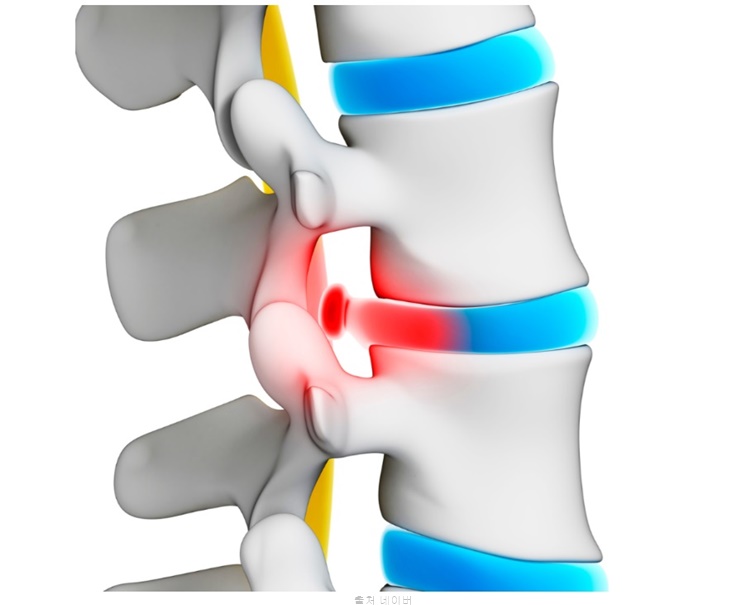 허리디스크 운동 일자 허리 통증 스트레칭