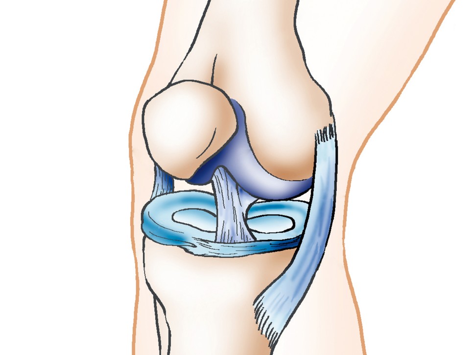 무릎 뒤쪽 오금에 발생하는 통증 원인 -  베이커 낭종 물혹 치료