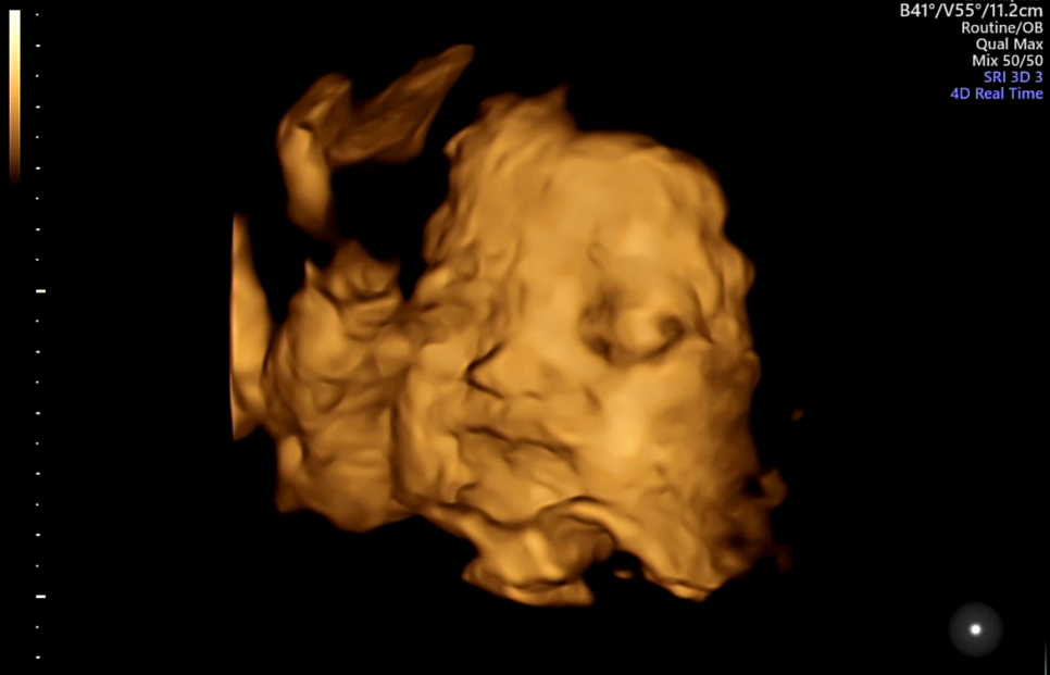 임신 28주 : 설렘 가득 입체초음파 ♥ 베이비페이스 추천코드 FTH2CYTD