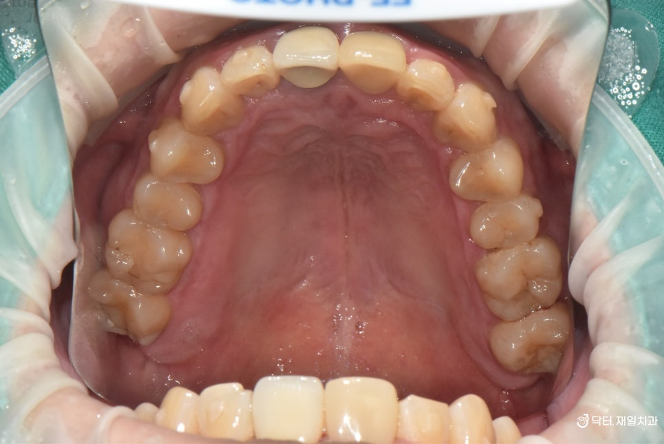 나이가 많아도 상관없는 진정한 복합진료 ! 치아교정과 동시에 한곳에서 임플란트 + 신경치료 + 보철치료까지 가능해야 환자분도 편하십니다 feat. 강동구교정치과 투명교정 case