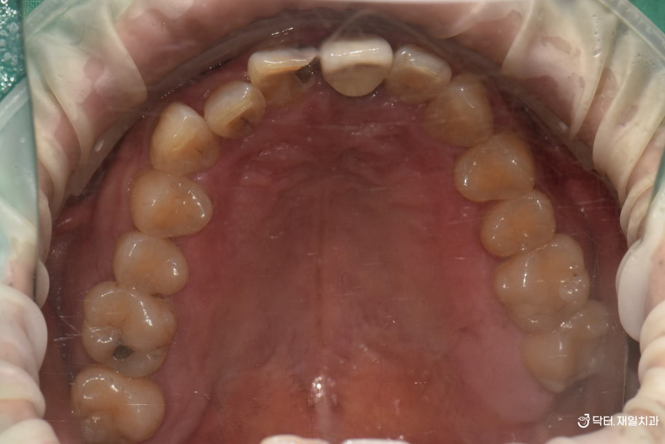 나이가 많아도 상관없는 진정한 복합진료 ! 치아교정과 동시에 한곳에서 임플란트 + 신경치료 + 보철치료까지 가능해야 환자분도 편하십니다 feat. 강동구교정치과 투명교정 case