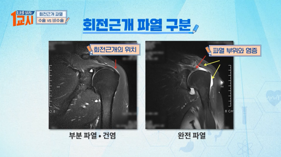 [MBC 나를 살리는 1교시] 연세사랑병원 관절센터 고용곤, 정성훈 의료진 인공관절수술 & 회전근개파열 특강