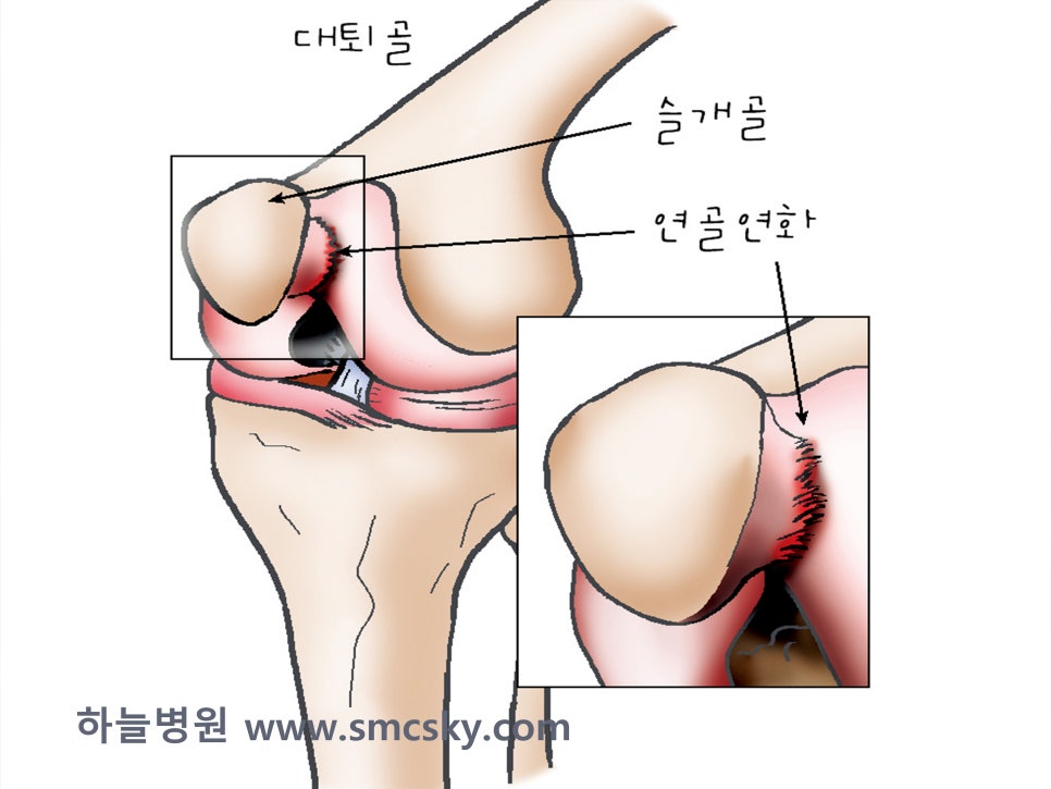 무릎 통증 원인이 되는 슬개골 연골연화증 증상 및 치료, 운동 테이핑 방법