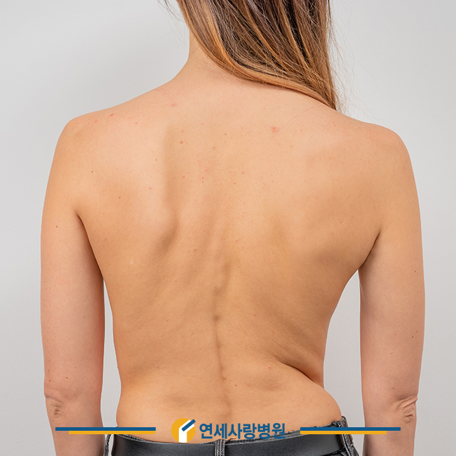 허리 굽음 척추후만증 원인과 치료법 파악해야