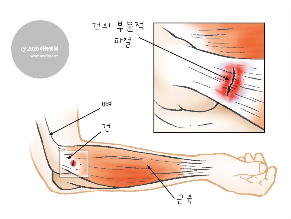 테니스 엘보 증상 및 팔꿈치 통증 도수치료 운동, 마사지 방법