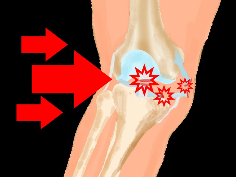 무릎 후방, 전방십자인대파열 증상 및 수술 치료, 재활 운동