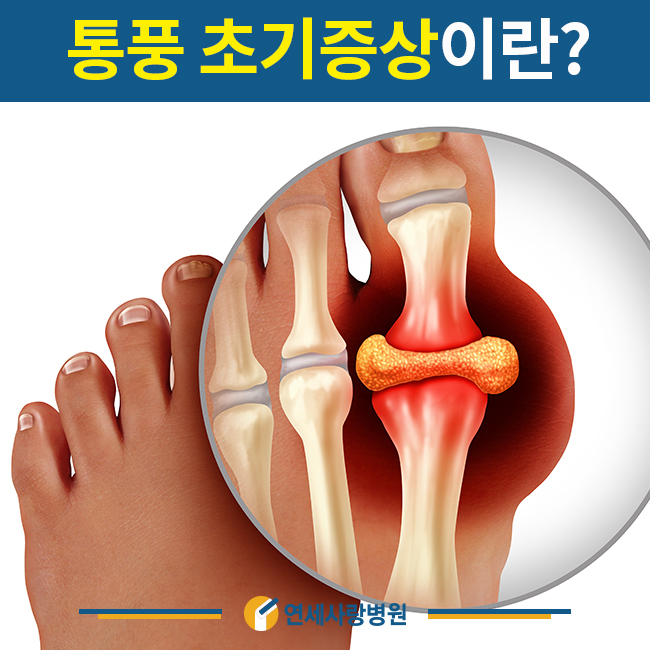 통풍 초기증상 바람만 스쳐도 극심하게 나타나