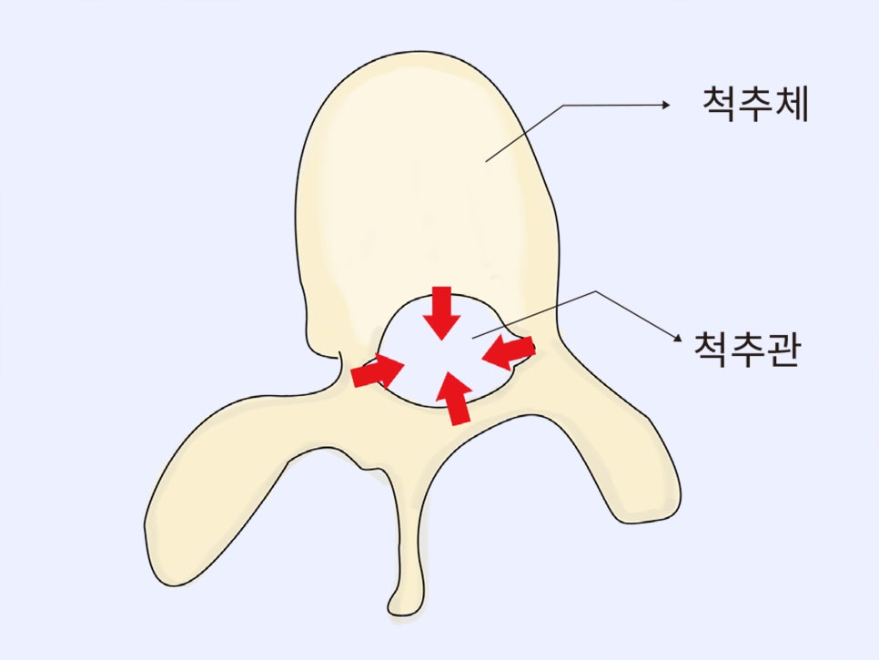 척추협착증(척추관협착증) 증상 및 치료, 운동 스트레칭 방법