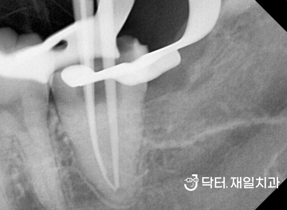 수면마취 치과에서 충치치료, 신경치료, 임플란트부터 앞니레진과 어금니인레이까지 잠자면서 여러 진료를 동시에 "너무 무서워서 치과가 10년만에 처음이에요"