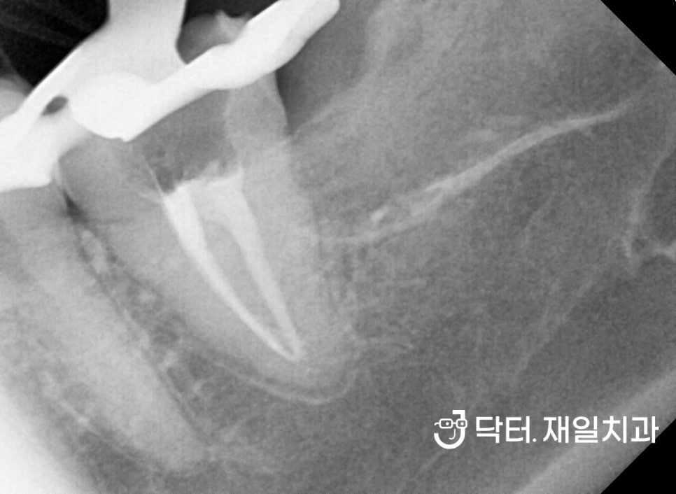 수면마취 치과에서 충치치료, 신경치료, 임플란트부터 앞니레진과 어금니인레이까지 잠자면서 여러 진료를 동시에 "너무 무서워서 치과가 10년만에 처음이에요"