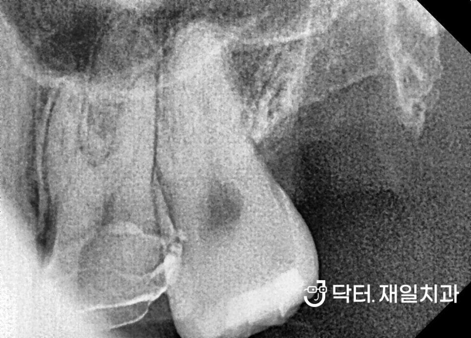 수면마취 치과에서 충치치료, 신경치료, 임플란트부터 앞니레진과 어금니인레이까지 잠자면서 여러 진료를 동시에 "너무 무서워서 치과가 10년만에 처음이에요"