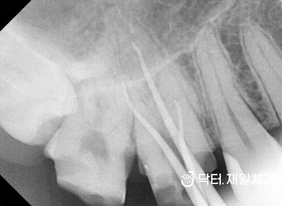 수면마취 치과에서 충치치료, 신경치료, 임플란트부터 앞니레진과 어금니인레이까지 잠자면서 여러 진료를 동시에 "너무 무서워서 치과가 10년만에 처음이에요"