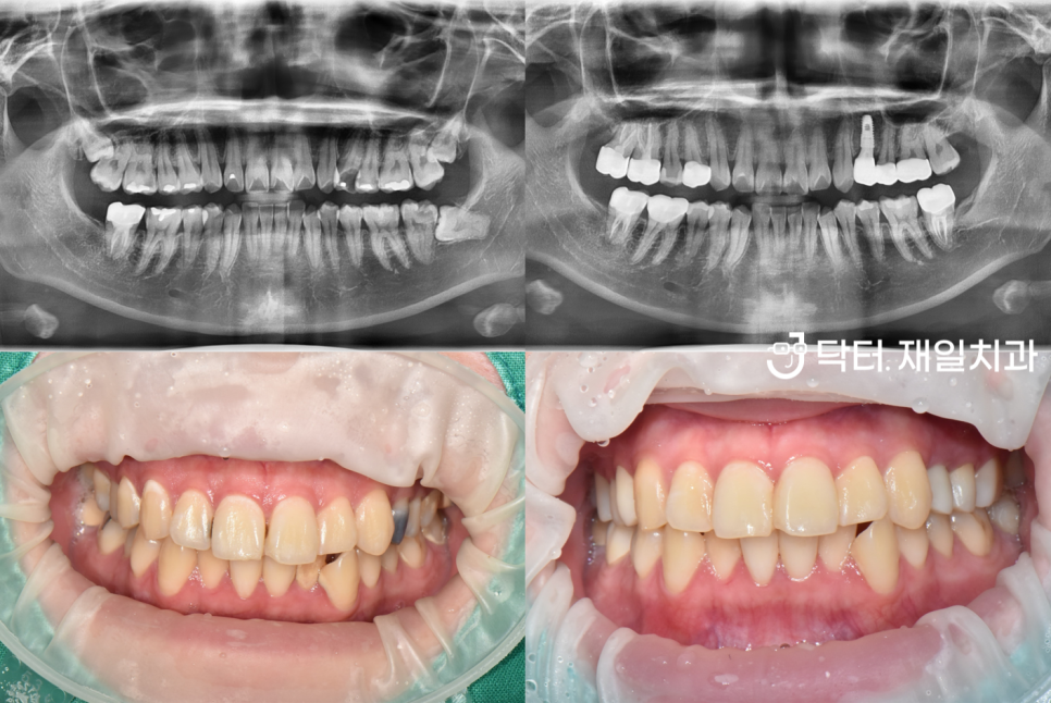 수면마취 치과에서 충치치료, 신경치료, 임플란트부터 앞니레진과 어금니인레이까지 잠자면서 여러 진료를 동시에 "너무 무서워서 치과가 10년만에 처음이에요"