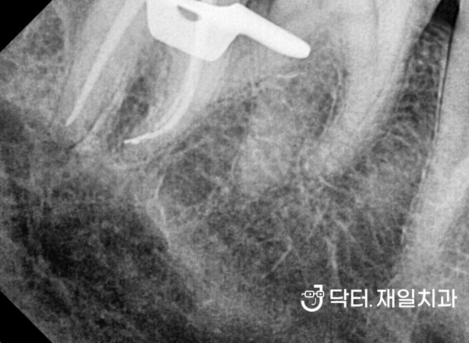 주말 일요일에도 임플란트부터 충치치료까지 저희 치과에서 하는 진료 ! 길동 성내동 둔촌동일요일치과