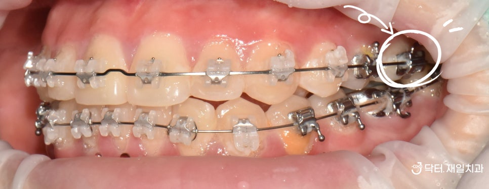 교정환자 충치치료 가능한가요 ? 잠실교정치과에서 저희 보존과전문의 원장님께 치아 구멍난 경우 신경치료 의뢰해주신 케이스