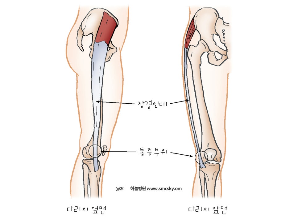 장경인대증후군 증상 및 무릎통증 치료(대퇴근막장근, 마사지 스트레칭, 테이핑 방법)