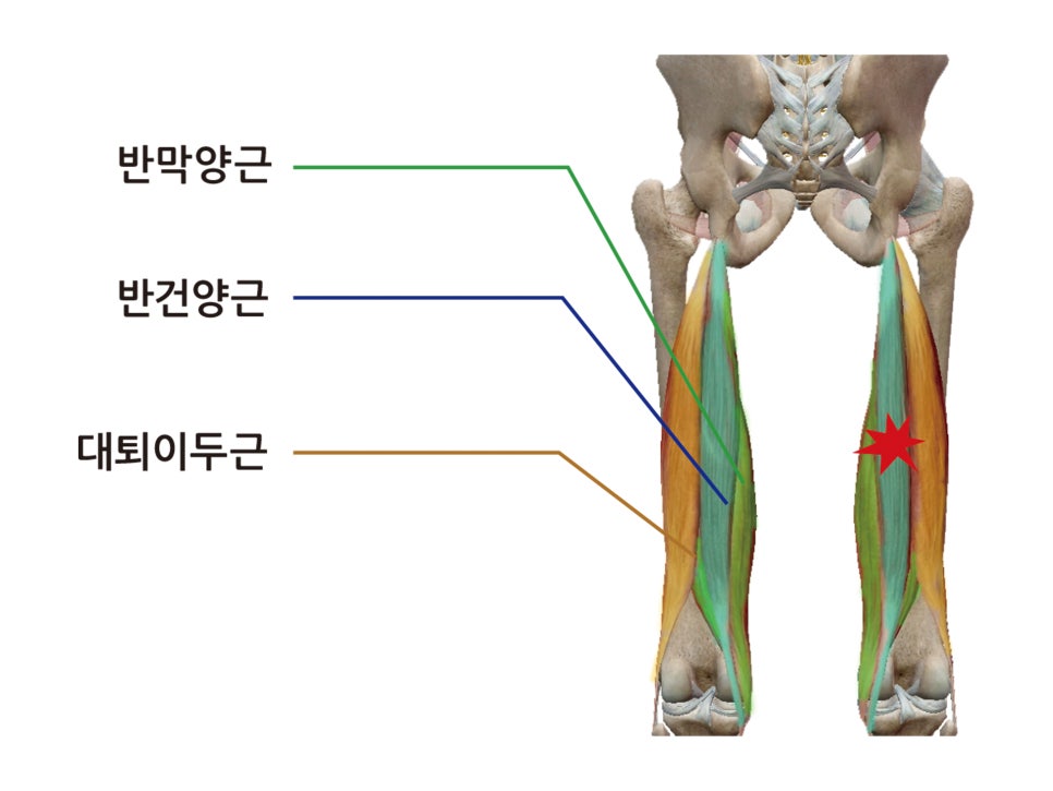 허벅지 뒤쪽 햄스트링 통증, 파열 증상 및 치료(운동 스트레칭 방법)