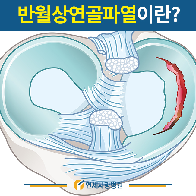 무릎 뒤쪽 통증 발생하는 이유