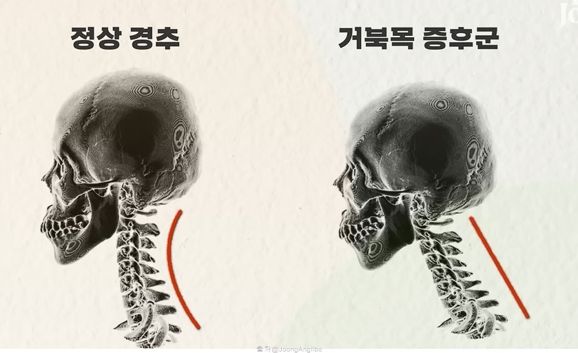 목디스크 치료방법 운동 집에서 하는 근력운동 목운동 목근육운동