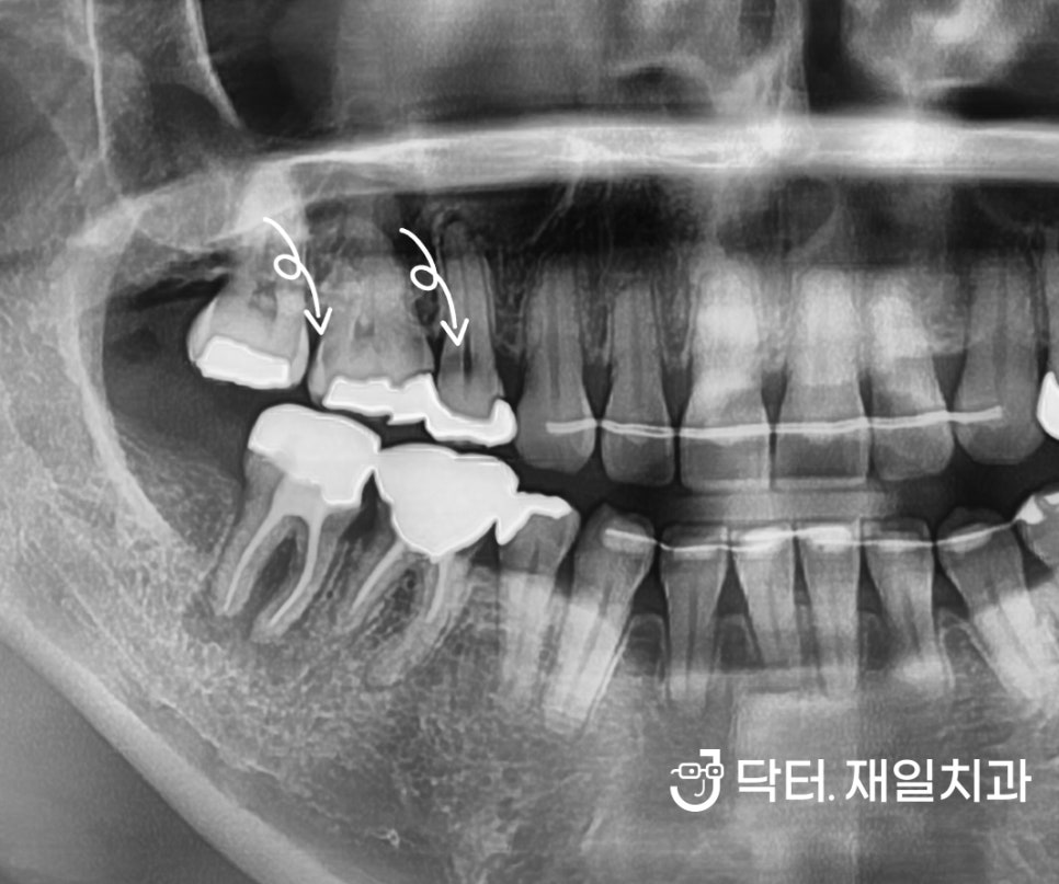 어금니시림이 나타나는 원인과 이시림 치료방법