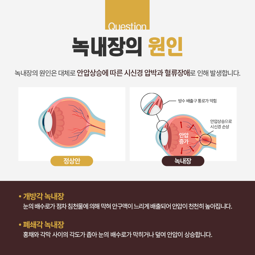 녹내장 초기증상 원인 치료