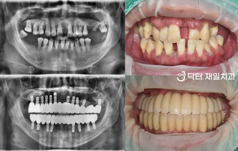 전체임플란트 수술을 수면마취로 받고자 강원도에서 오신 치과 공포증 40대 환자분 ! 명일동 천호동치과 임플란트