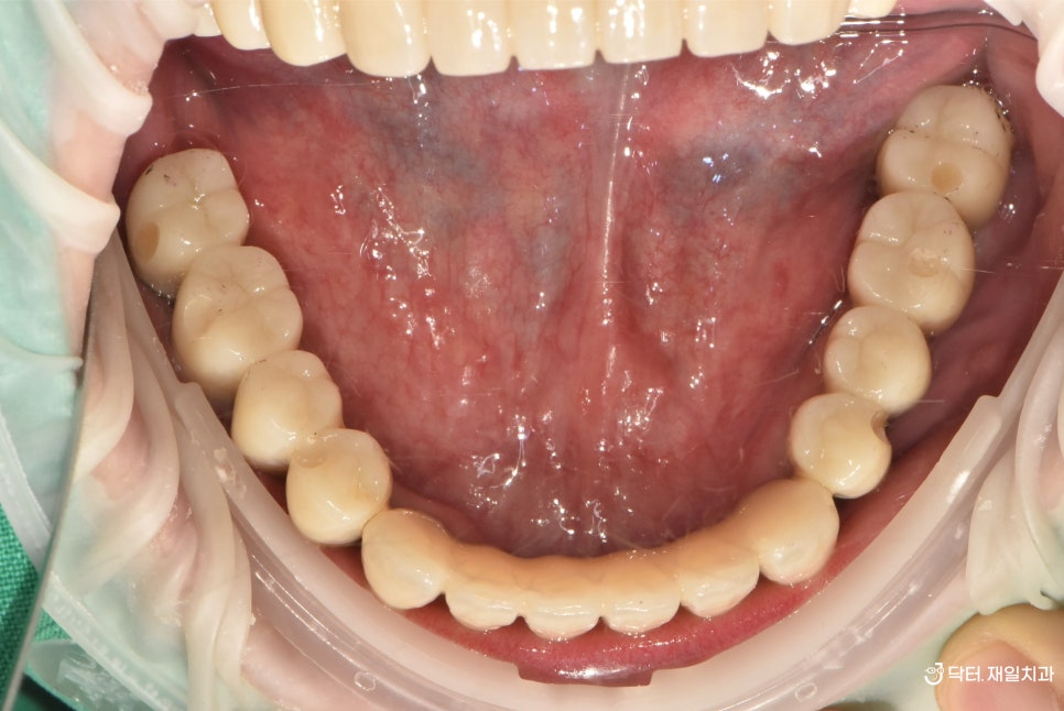전체임플란트 수술을 수면마취로 받고자 강원도에서 오신 치과 공포증 40대 환자분 ! 명일동 천호동치과 임플란트
