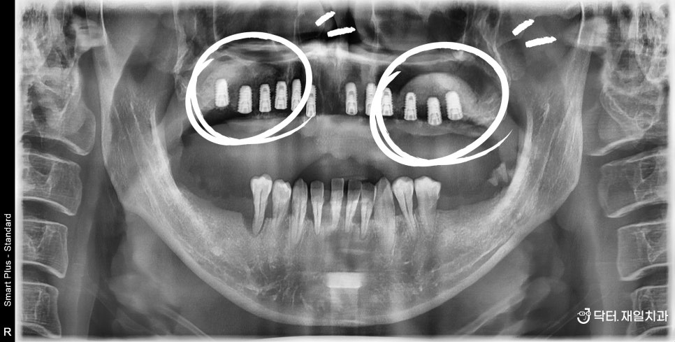 전체임플란트 수술을 수면마취로 받고자 강원도에서 오신 치과 공포증 40대 환자분 ! 명일동 천호동치과 임플란트