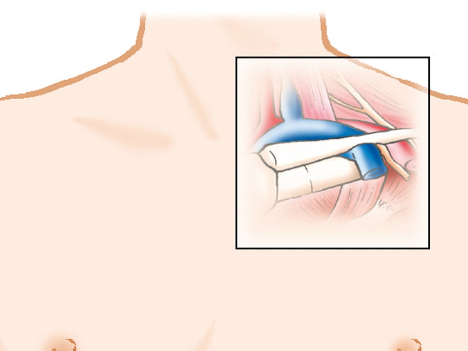 흉곽출구증후군 증상 및 치료 병원(팔저림 손저림 통증)