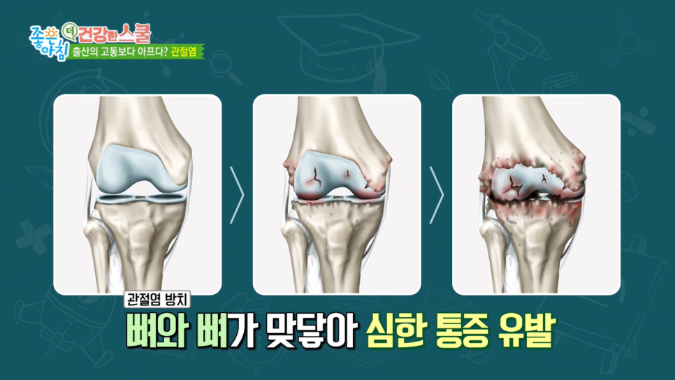 SBS 좋은아침 [더 건강한 스쿨] 고용곤, 정재현 연세사랑병원 의료진 중년 여성 관절염과 골다공증 예방 특강