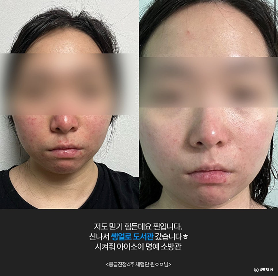 효과 대박인 피부 트러블 응급진정세럼 아이소이 진정초능력 놀라워