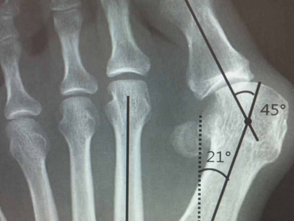 무지외반증 증상 및 운동, 수술 치료 병원(엄지발가락 통증)