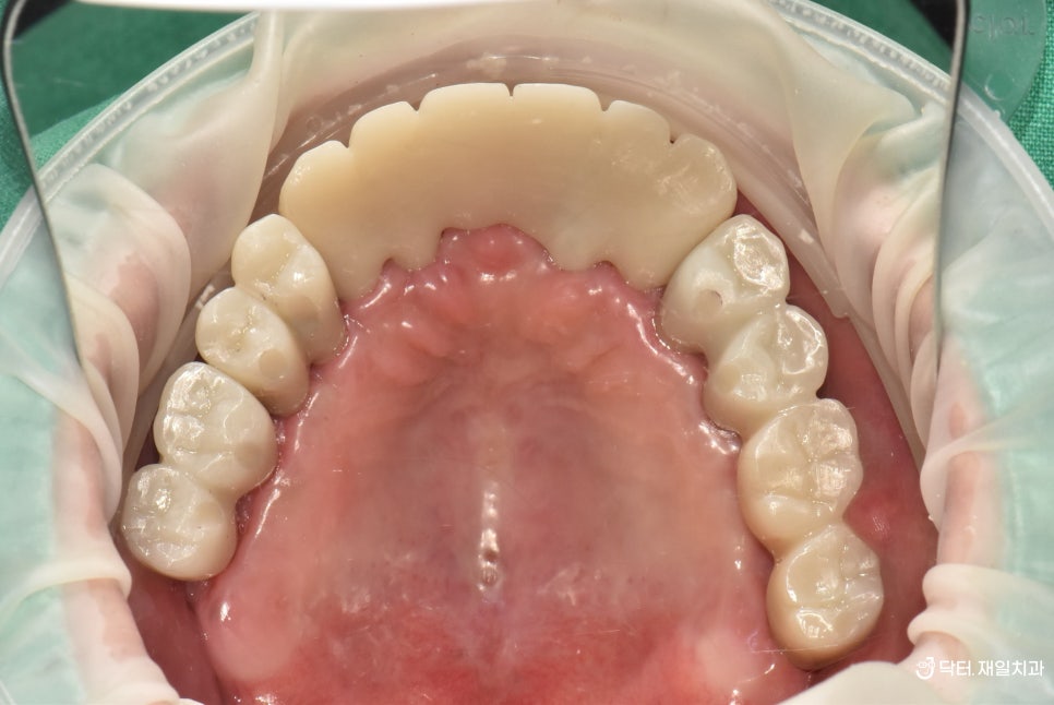 전체임플란트 수술을 수면마취로 받고자 강원도에서 오신 치과 공포증 40대 환자분 ! 명일동 천호동치과 임플란트