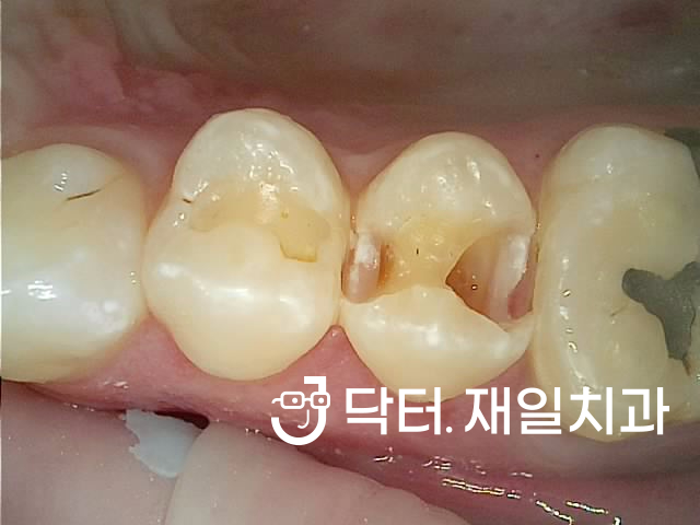 수면진료로 당일에 끝내는 앞니 잇몸 염증 있는 외국인 신경치료 치근단절제술 후 크라운까지 고덕 명일치과에서