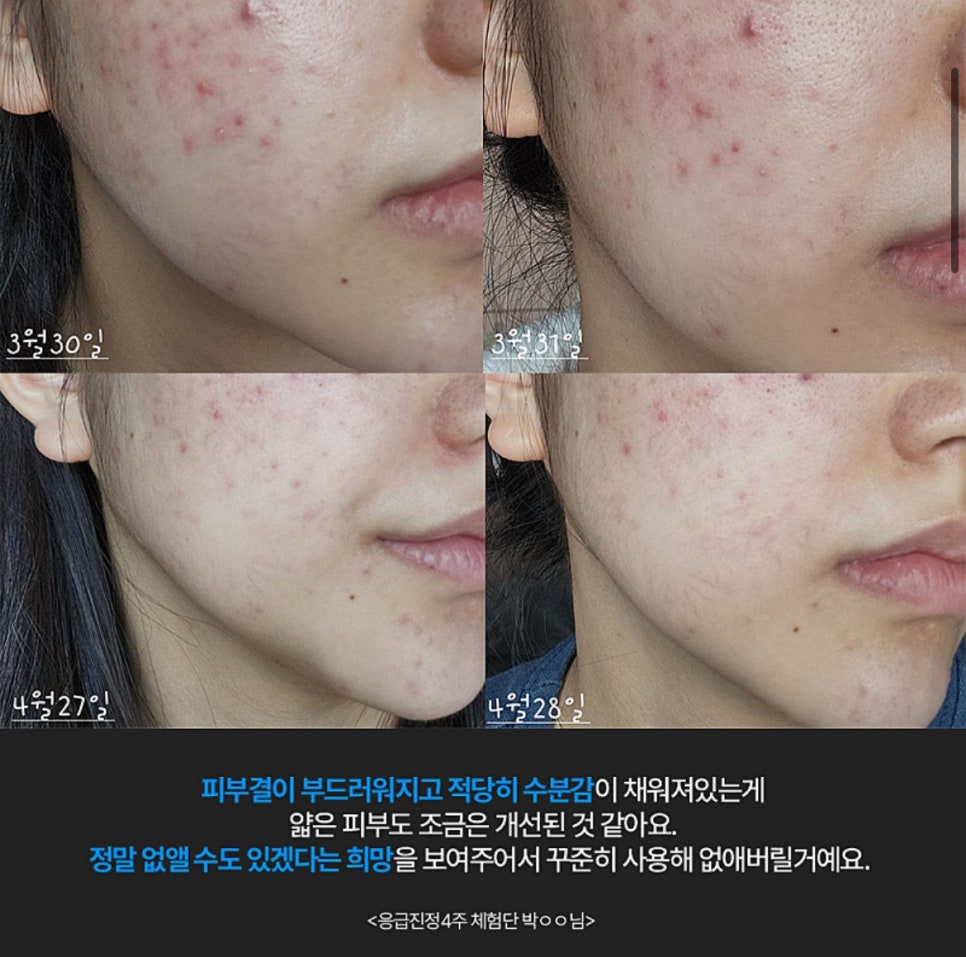 아이소이 응급진정세럼 트러블 진정 초능력 응급진정 4주후기까지