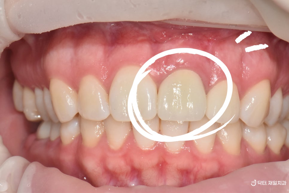 수면진료로 당일에 끝내는 앞니 잇몸 염증 있는 외국인 신경치료 치근단절제술 후 크라운까지 고덕 명일치과에서