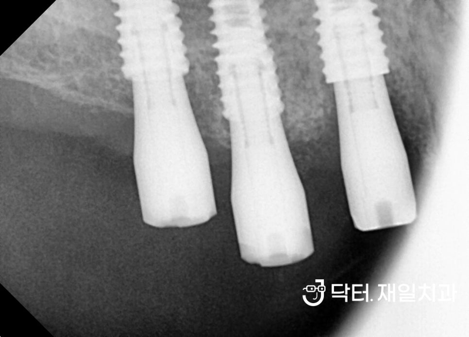 임플란트재수술 필요할때 수면마취로 어금니통증 줄이고자 청주에서 내원하신 50대 환자분 ! 고덕동 명일역임플란트 치과