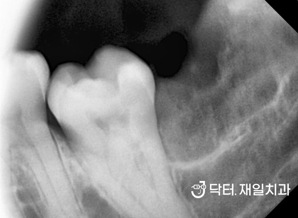 수면진료로 당일에 끝내는 앞니 잇몸 염증 있는 외국인 신경치료 치근단절제술 후 크라운까지 고덕 명일치과에서