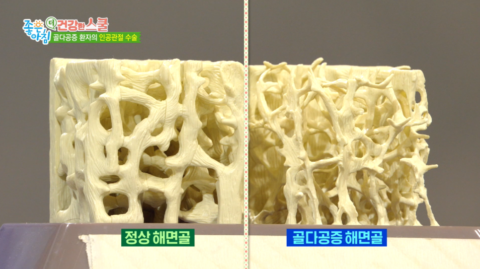 SBS 좋은아침 [더 건강한 스쿨] 고용곤, 정재현 연세사랑병원 의료진 중년 여성 관절염과 골다공증 예방 특강