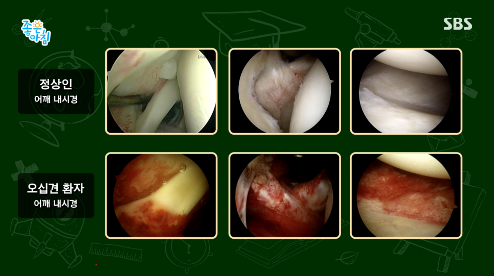 SBS 좋은아침 더 건강한 스쿨 무릎 인공관절수술과 오십견 연세사랑병원 의료진 특강(feat.고용곤, 김철)