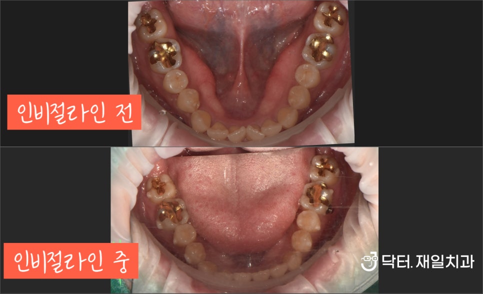 인비절라인 후기를 통한 전후 비교 ! 결혼때문에 치아교정 중단하고 이사간 직원 이야기 feat. 골융기제거와 고난이도 사랑니발치까지